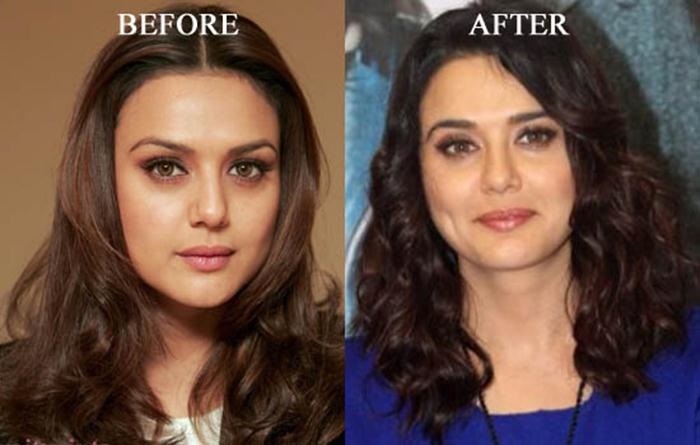 List Of Bollywood Actresses Who Have Had Cosmetic Surgery Some Are Disasters Meneses Acurnhooks