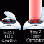 Laser & Lasik Eye Surgery Guide - How It Works, Cost, & Risks 2