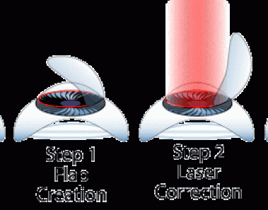 Laser & Lasik Eye Surgery Guide - How It Works, Cost, & Risks 1