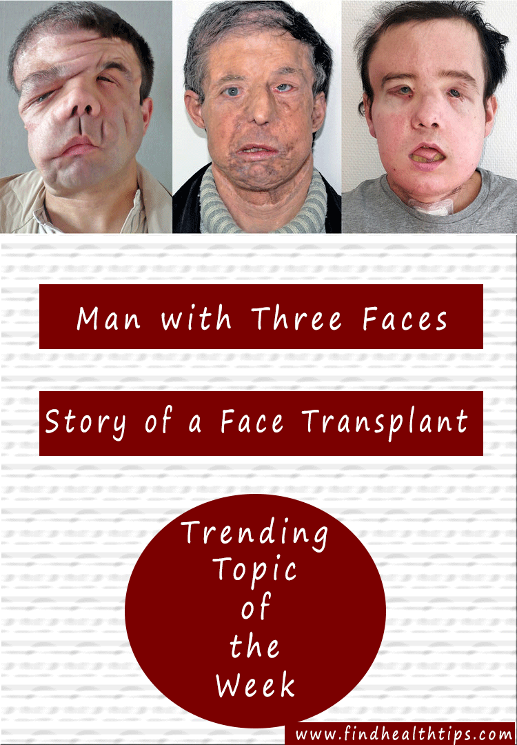 Who Is The Man With Three Faces And His Second Face Transplant Truth