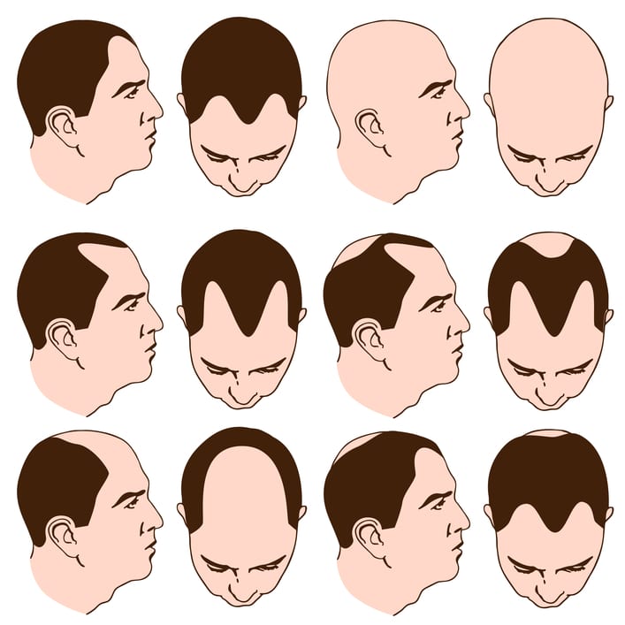 baldness pattern