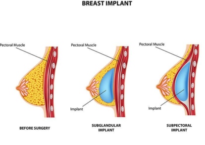 Breast Implant Complications