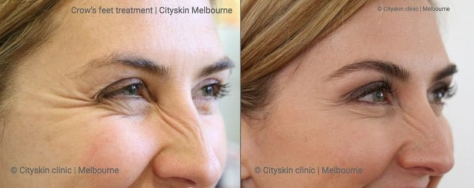 Anti Wrinkle Injection Effects | Beffore and After Photos