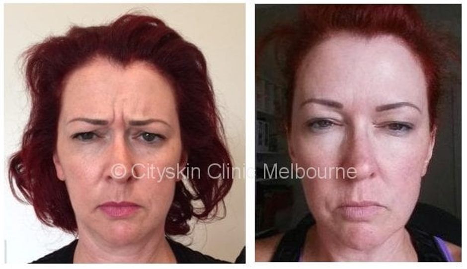 The As, Bs and Cs of Anti-Wrinkle Injections 3 Anti Wrinkle Injections effect | Before an After Photos