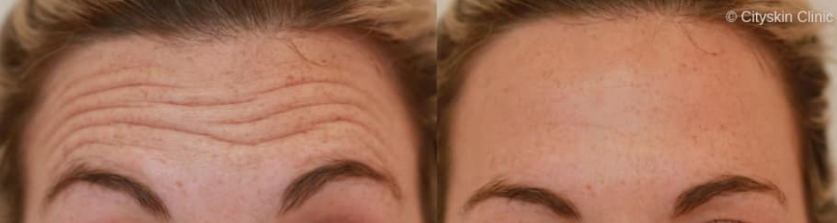 The As, Bs and Cs of Anti-Wrinkle Injections 1 Anti Wrinkle