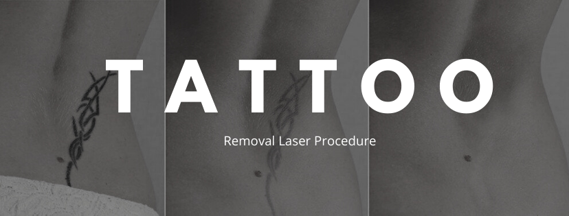 tattoo removal laser procedure