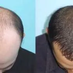 Hair Transplant