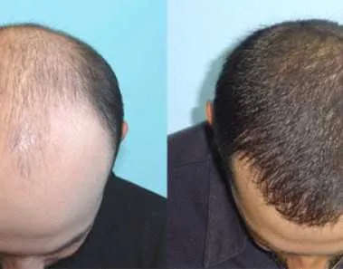 Hair Transplant Procedure, Average Cost, Risk, and Treatment 1 Hair Transplant