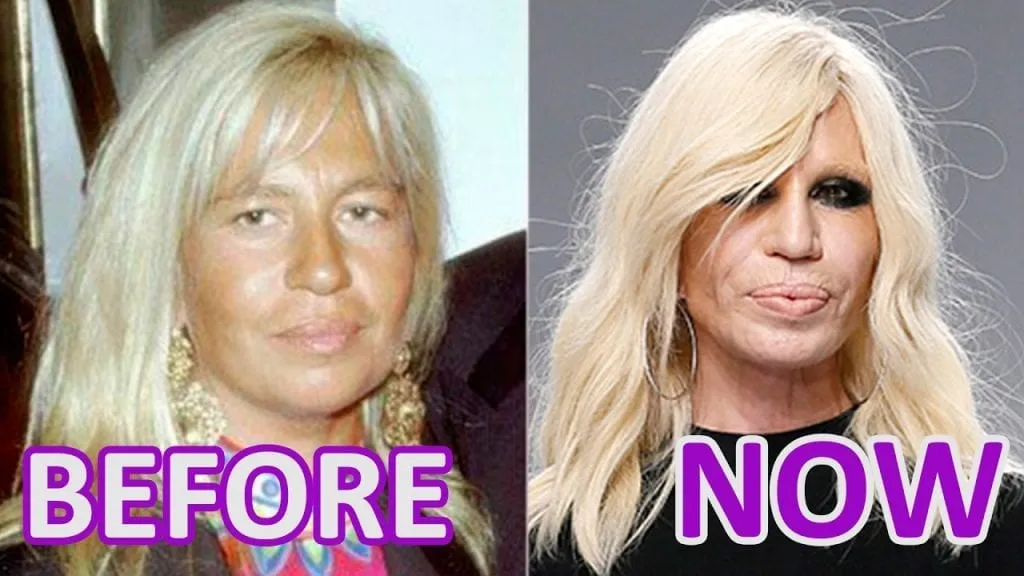 Top Celebrities Who Have Done Plastic Surgery 5 Donatella Versace before and after plastic surgery