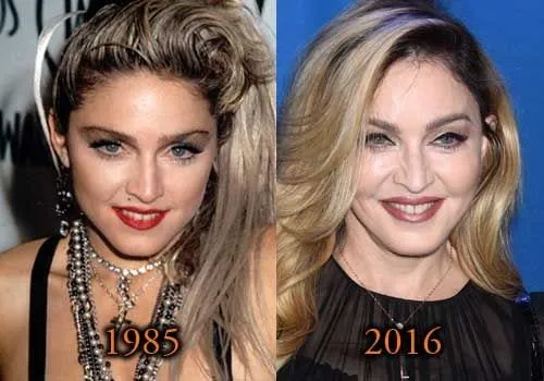 Top Celebrities Who Have Done Plastic Surgery 7 Madonna before and after plastic surgery