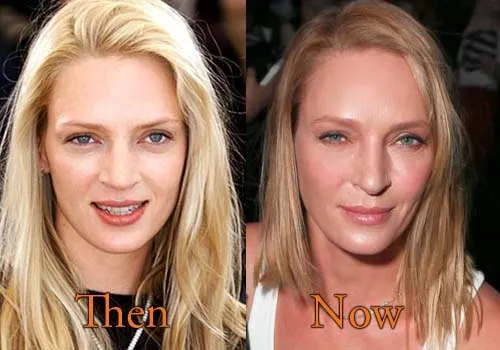 Top Celebrities Who Have Done Plastic Surgery 12 Uma Thurman before and after plastic surgery