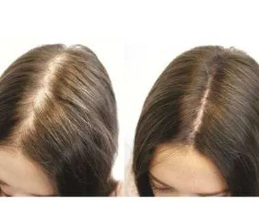 Home Remedies to Regrow Hair 1 hair regrowth before and after