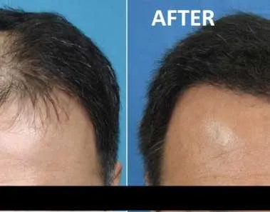 Stem cell Hair Treatment