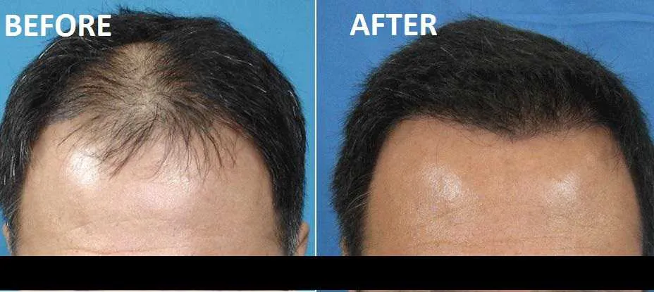 Can Scientists Grow New Hair with Stem Cells?