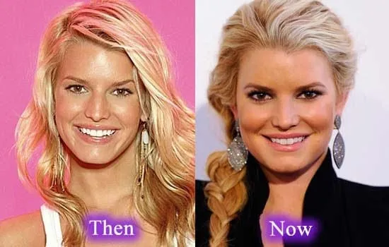 Top Celebrities Who Have Done Plastic Surgery 11 jessica simpson before and after plastic surgery