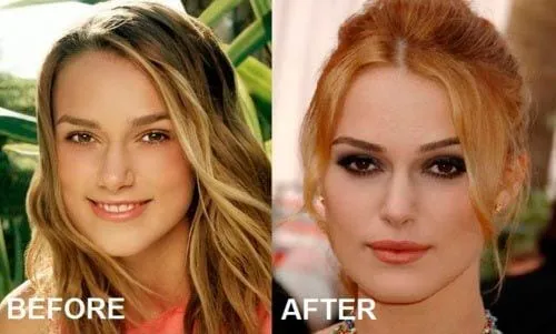 Top Celebrities Who Have Done Plastic Surgery 4 keira knightley before and after plastic surgery