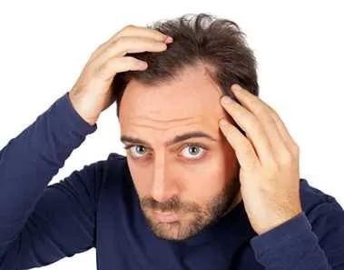 male hair loss