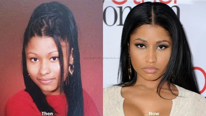 Top Celebrities Who Have Done Plastic Surgery 13 nicki minaj plastic surgery before after