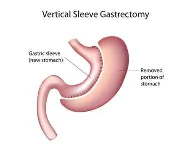 What Is Gastric Sleeve Weight Loss Surgery? 1 gastric weight loss surgery