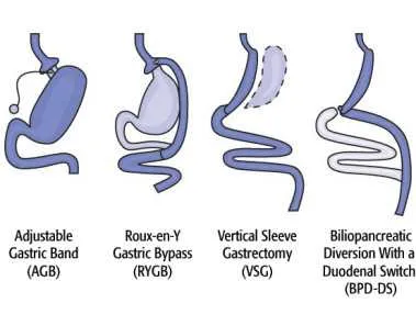 Types of Weight Loss Surgery 1 types of weight loss surgery