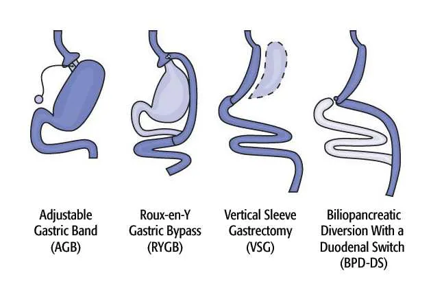 Types of Weight Loss Surgery