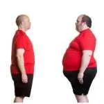 weight loss surgery