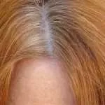 flaky scalp