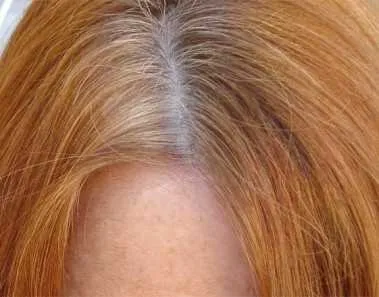 flaky scalp