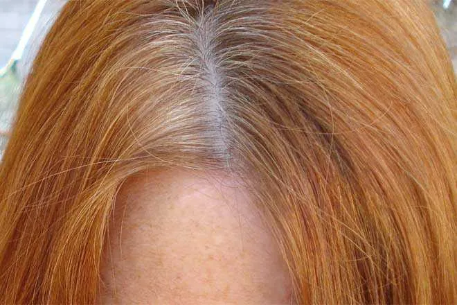 Causes of Dry, Flaky Scalp