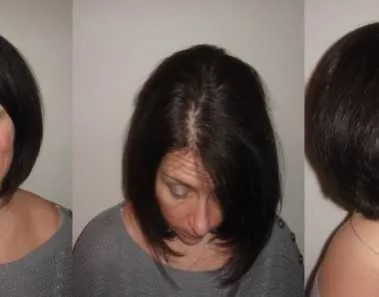 How to Prevent Hair Loss While Losing Weight 1