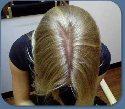 weight loss hair loss weight loss hair loss