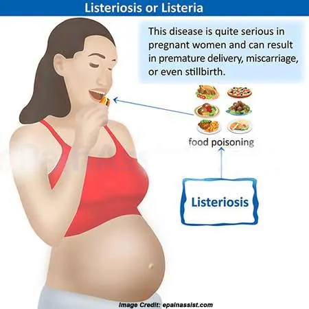 listeriosis listeriosis