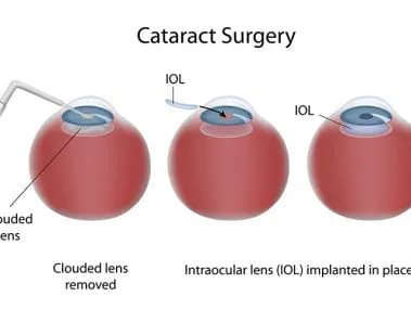 lasik cataract surgery