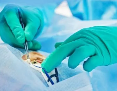 lasik eye surgery information