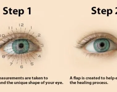 vision correction surgery