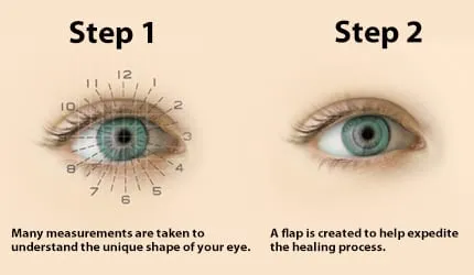 Vision Correction Surgery Types: Benefits, Risks, and More