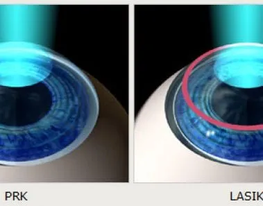 PRK vs. LASIK. Why is PRK right for you? 1 PRK vs LASIK