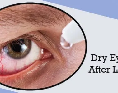 dry eyes after lasik