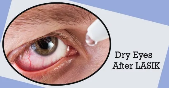 Dry Eyes Before and After LASIK