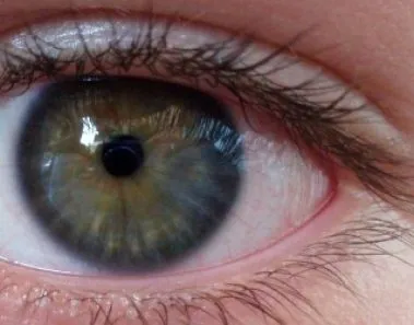 lasik eye surgery risks