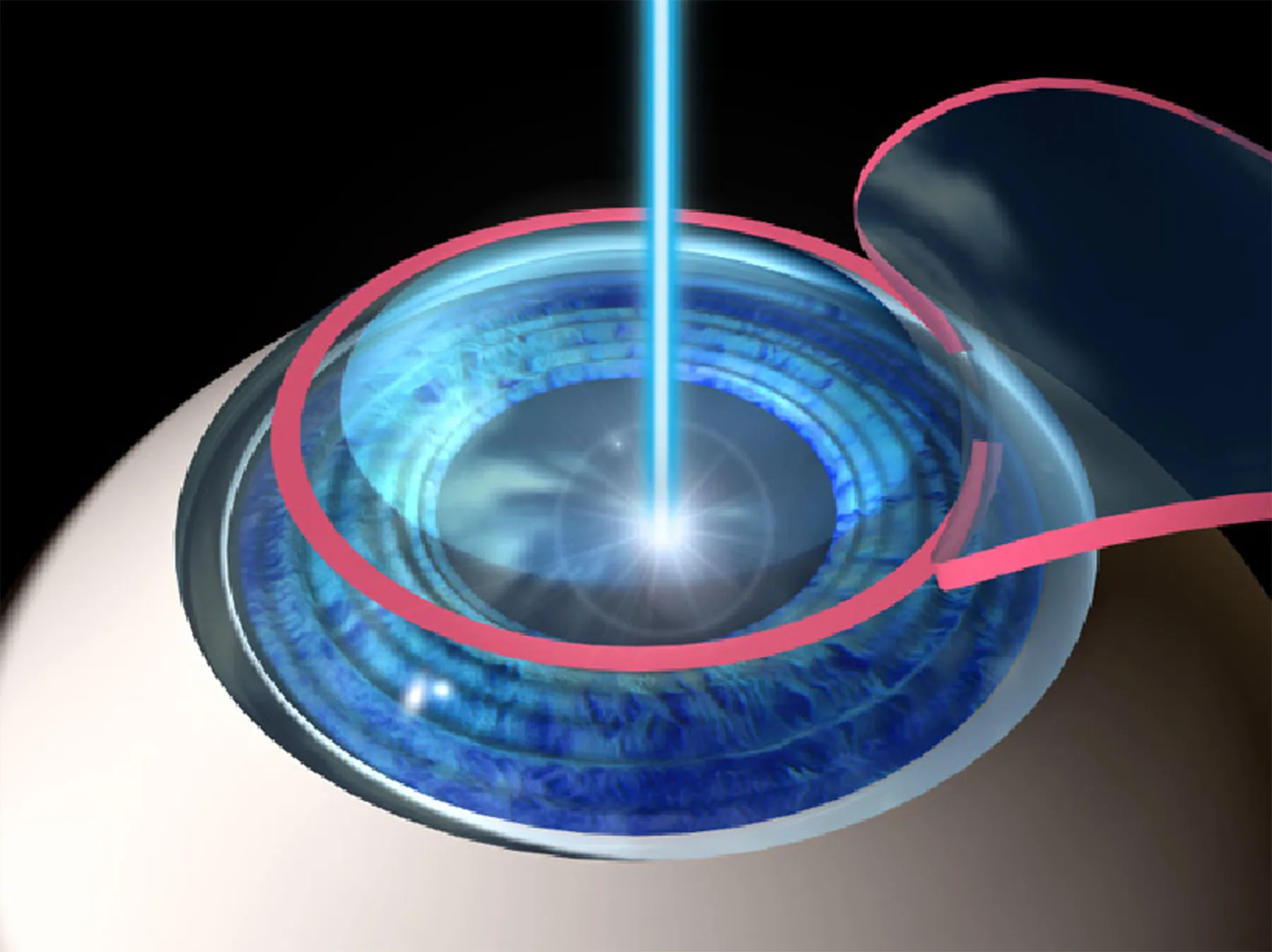 lasik eye surgery