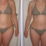 HCG Weight Loss