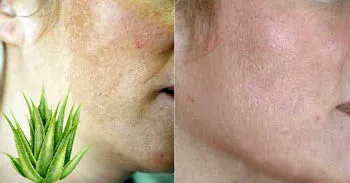 aloe vera for pigmentation