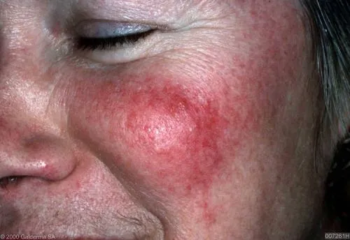 Rosacea: Causes and Treatments 1 rosacea