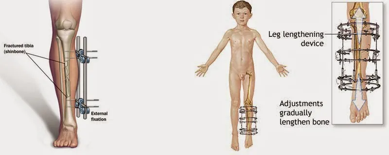 Height Increasing Surgery Cost in India 1 Height Increasing Surgery India