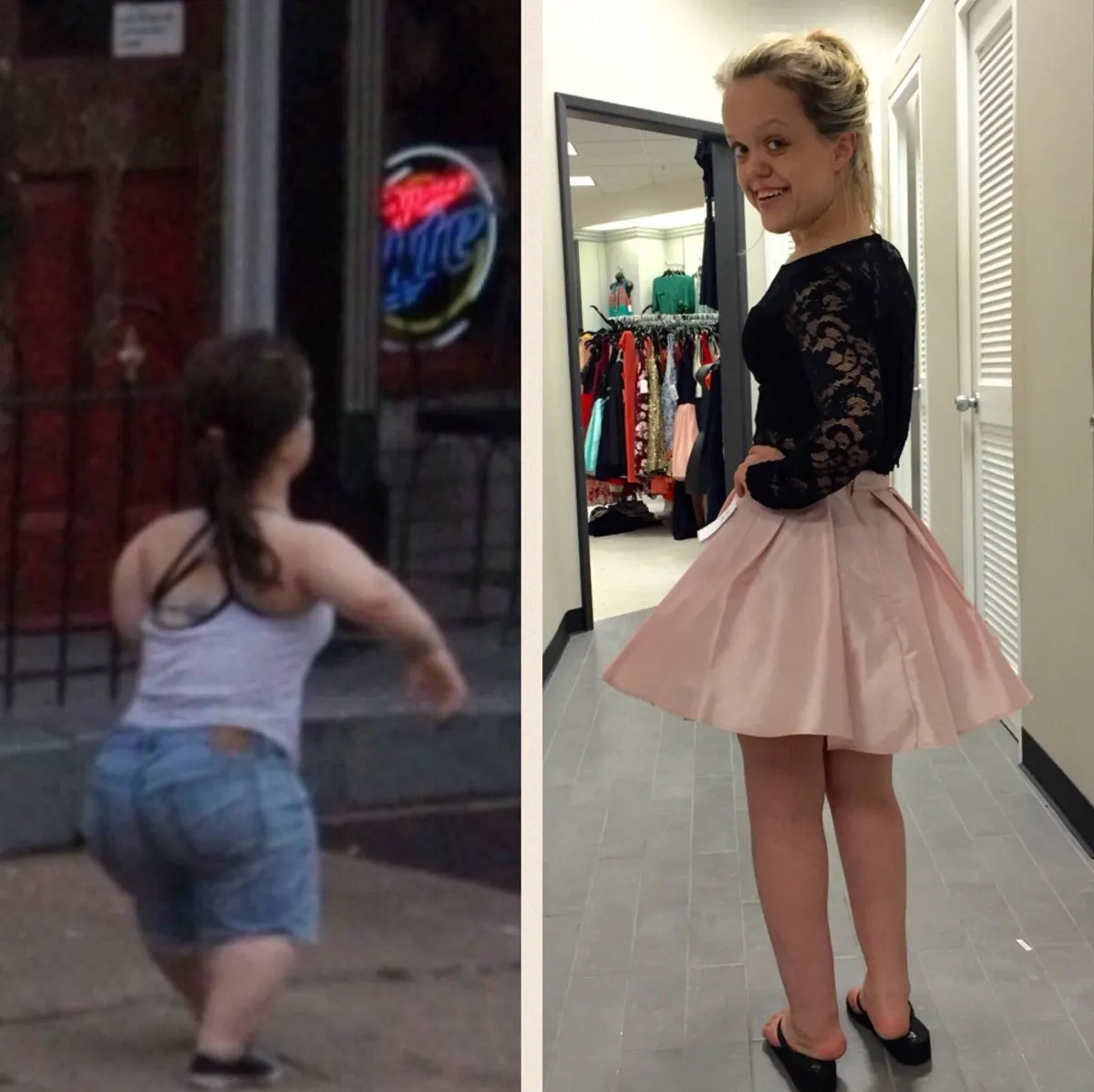 Should You Choose Limb Lengthening (Grow Taller) Surgery? 1 limb lengthening surgery - grow taller surgery