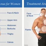 liposuction fat loss surgery
