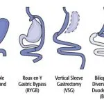 bariatric surgery centers germany