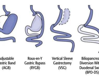 bariatric surgery centers germany