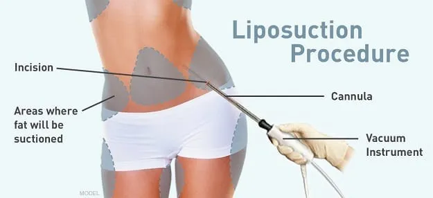 13 Most Extreme Ways to Lose Weight 2 Liposuction
